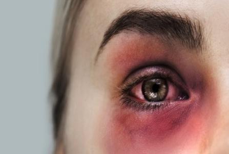 Woman with black eye